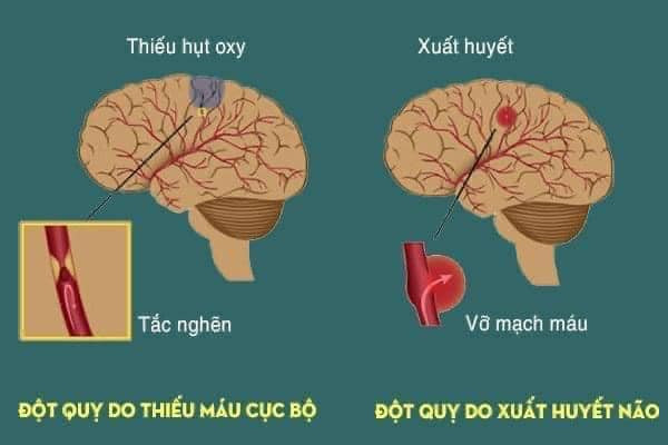 Cảnh báo nguy cơ đột quỵ khi thời tiết chuyển lạnh