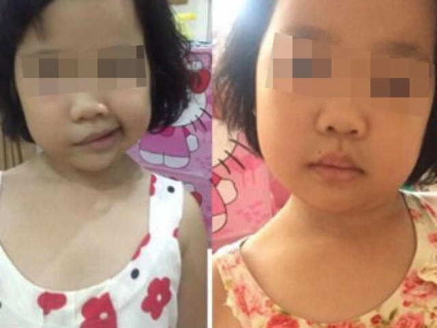 Hướng dẫn cha mẹ cách chăm sóc và tập luyện tại nhà cho trẻ bị liệt dây thần kinh số 7 ngoại biên