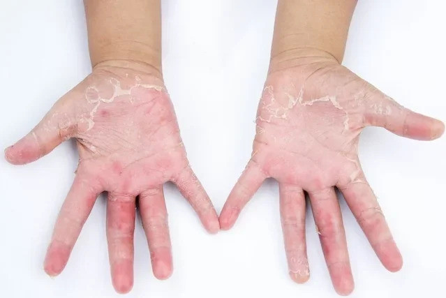Nguyên nhân, triệu chứng và cách điều trị dị ứng tay