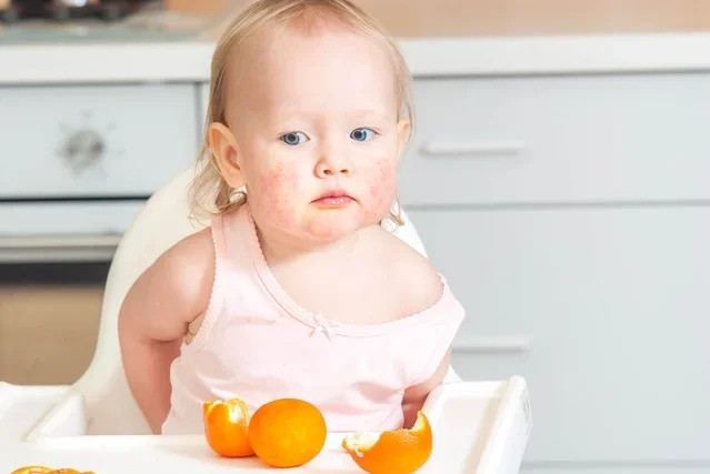 Nguyên nhân, triệu chứng và cách điều trị dị ứng thực phẩm
