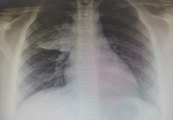 Vĩnh Long liên tục tiếp nhận điều trị nhiều trường hợp trẻ nhập viện do viêm phổi