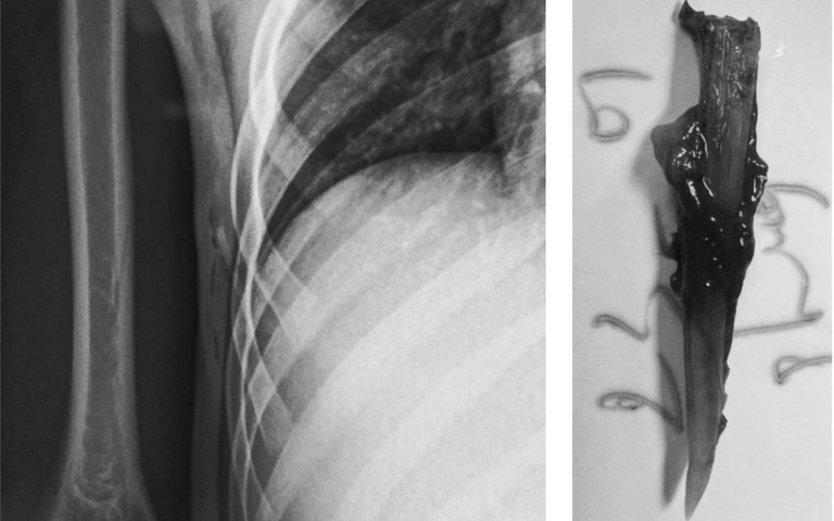 Sóc Trăng: Cấp cứu bệnh nhi 14 tuổi bị gai cá đâm vào vùng ngực
