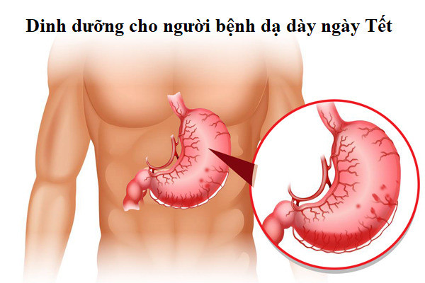 Những kiêng kị ngày Tết dành cho người bệnh dạ dày