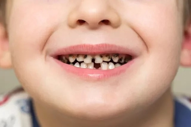 4 nguyên nhân chính của răng sâu