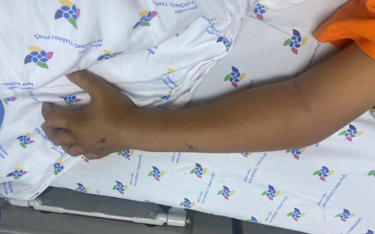 TP. Hồ Chí Minh: Bé trai 8 tuổi nhập viện cấp cứu do bị rắn lục cắn gây rối loạn đông máu nặng