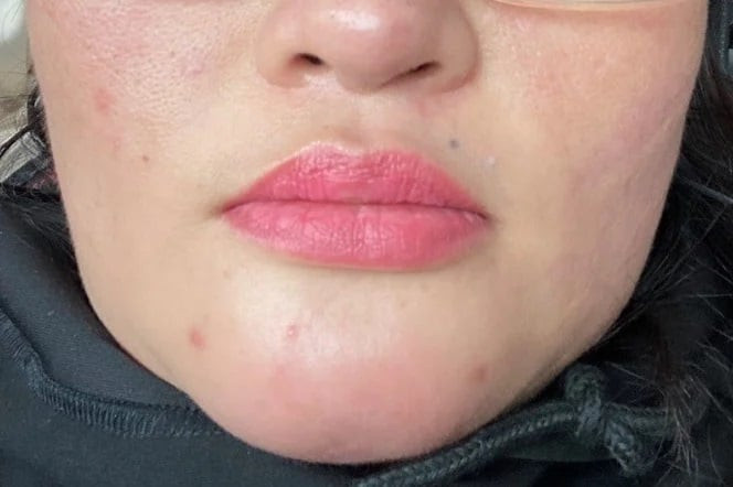 Nhiều trường hợp biến chứng sau tiêm filler để làm đẹp