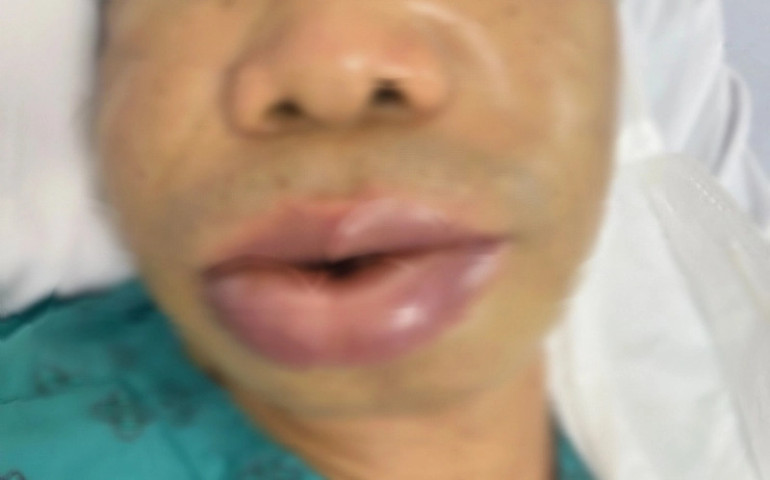Tìm hiểu về bệnh phù mạch di truyền
