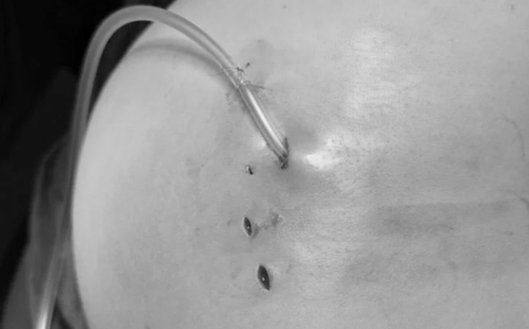 Điều trị cho 1 bệnh nhân bị biến chứng sau khi tiêm filler vào vùng mông