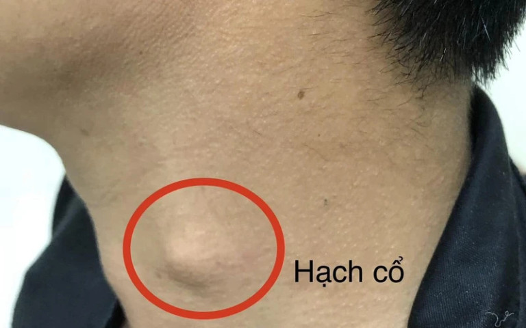 Phú Thọ: Nam bệnh nhân 59 tuổi sút cân nhiều, nuốt nghẹn, đi khám phát hiện bị ung thư thực quản
