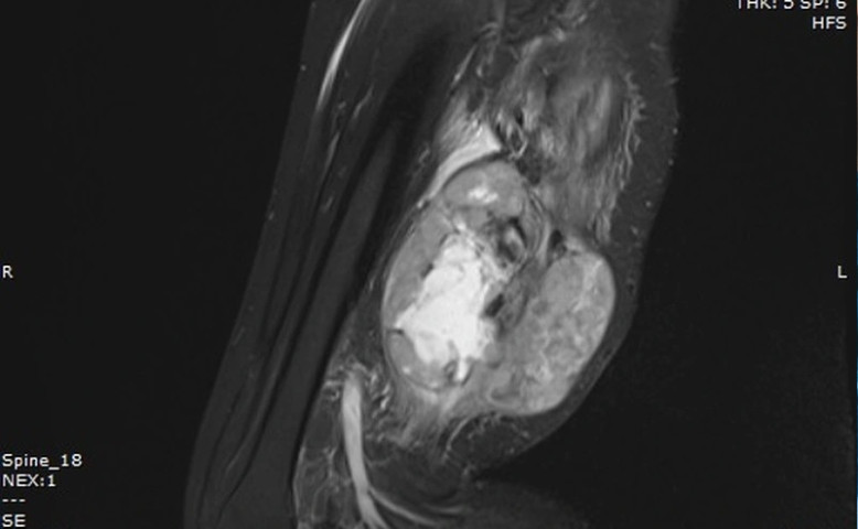 Quảng Ninh: Phẫu thuật lấy toàn bộ khối sarcoma sụn ác tính hiếm gặp, giúp bệnh nhân thoát nguy cơ cắt cụt chi