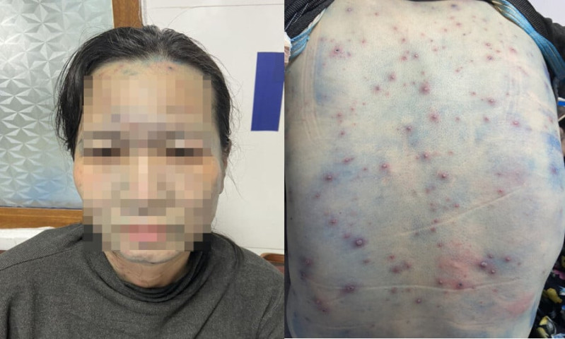 Cảnh báo biến chứng thủy đậu gây nguy hiểm cho sức khỏe người bệnh