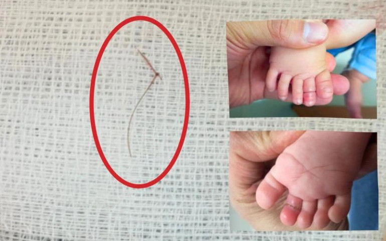 Nghệ An: Bé gái 4 tháng tuổi suýt mất ngón chân do vướng phải sợi tóc
