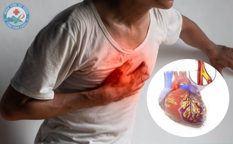 Vĩnh Phúc: Cấp cứu thành công 1 bệnh nhân 57 tuổi bị nhồi máu cơ tim cấp