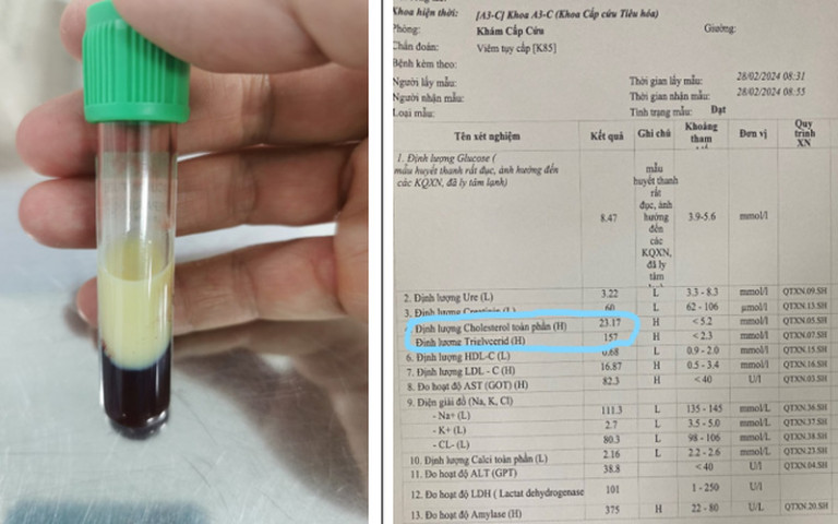 Hà Nội: Điều trị thành công 1 bệnh nhân viêm tụy cấp mức độ nặng do tăng triglyceride máu