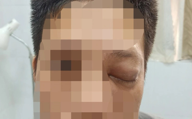 Vĩnh Long: Điều trị cho bệnh nhân bị nhiễm trùng tiền đình mũi do tụ cầu kháng thuốc