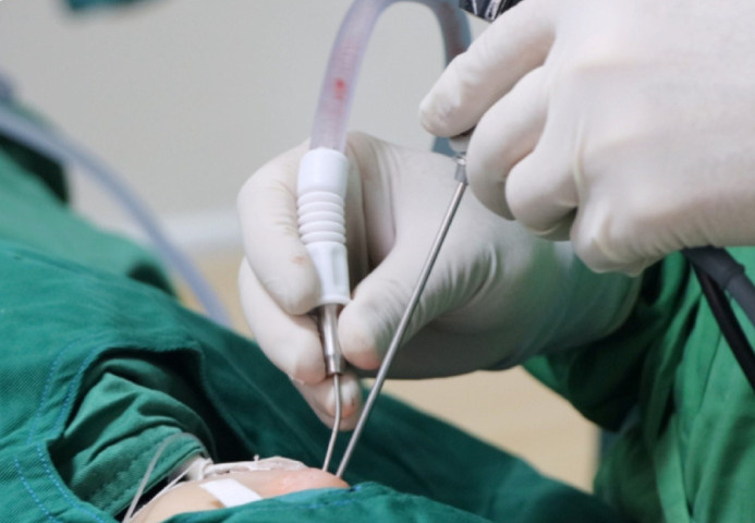 Hưng Yên: Phẫu thuật tách dính, chỉnh lại niêm mạc cuốn dưới 2 bên và nạo VA cho bệnh nhi 21 tháng tuổi