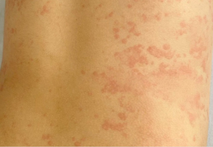 Vĩnh Long cấp cứu bé trai bị phản vệ nghi do tiêm ngừa