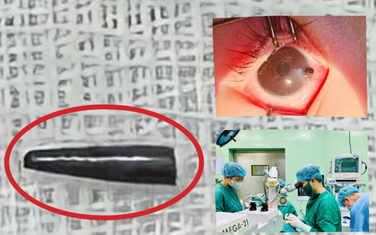 Nghệ An: Cấp cứu bệnh nhi 9 tuổi bị ruột bút chì đâm xuyên thủng nhãn cầu mắt phải