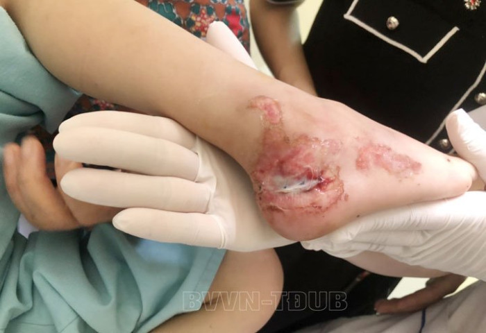 Quảng Ninh xử lý vết thương bị kẹp gót chân phải vào nan hoa xe đạp cho bé trai 5 tuổi