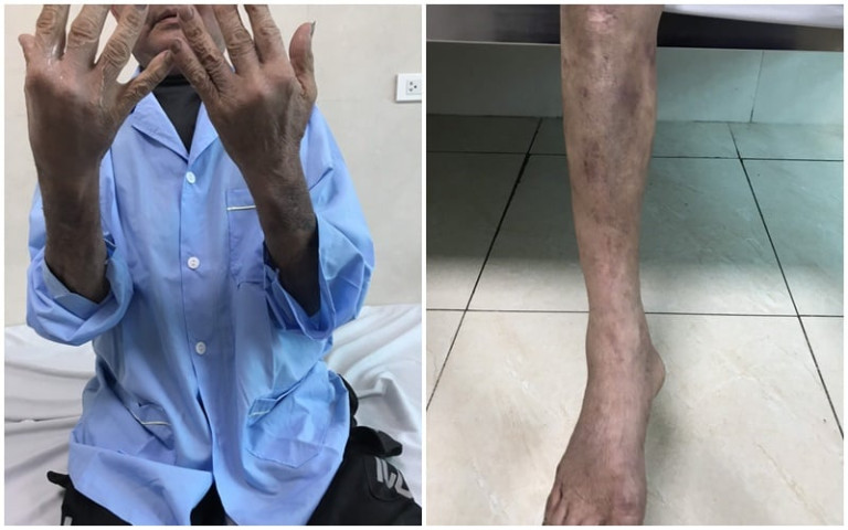 Phú Thọ: Điều trị cho 1 bệnh nhân bị suy tuyến thượng thận do tự điều trị bệnh bằng thuốc không rõ nguồn gốc tại nhà