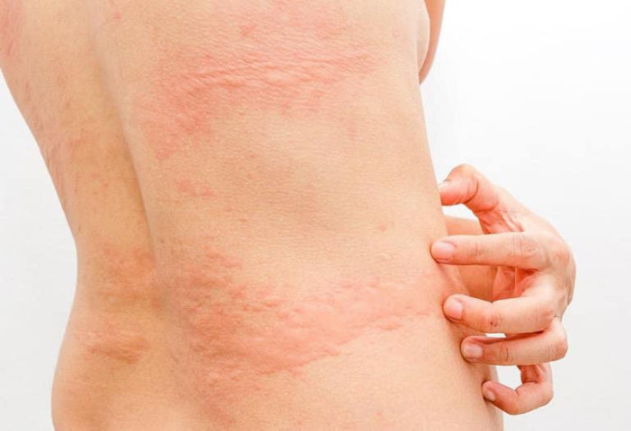 Bài thuốc bổ gan giảm các bệnh ngoài da