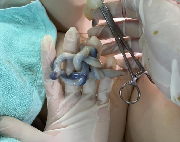 Quảng Nam: Sản phụ sinh thường em bé có dây rốn thắt nút 2 vị trí cách nhau khoảng 10 cm