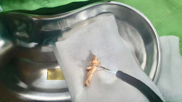Sơn La: Nội soi gắp chiếc xương gà có kích thước khoảng 3 cm trong thực quản bệnh nhân