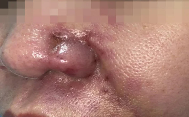 Người phụ nữ bị biến chứng sau khi tiêm filler vùng mũi má tại một cơ sở "người quen"