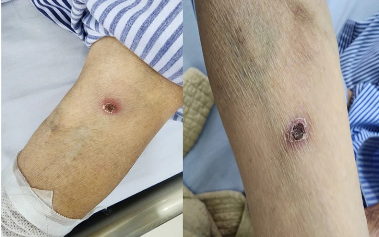 Điều trị cho bệnh nhân nữ 71 tuổi bị sốt mò có bệnh nền đái tháo đường