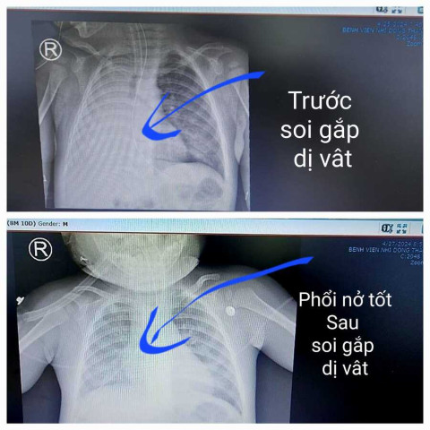 TP. Hồ Chí Minh: Nội soi gắp thành công dị vật cuống xoài trong đường thở do trẻ bị hóc sặc trong lúc ăn dặm