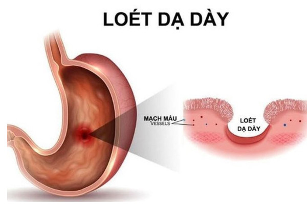 Những dấu hiệu thầm lặng cảnh báo loét dạ dày