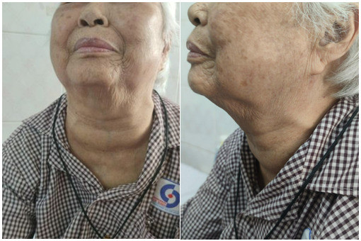 TP. Hồ Chí Minh: Phẫu thuật thành công cho cụ bà 95 tuổi có bướu cổ khổng lồ chèn ép khí quản