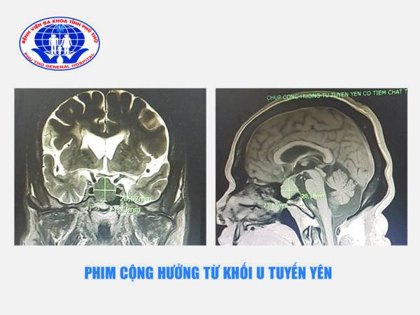 Phú Thọ: Lần đầu trong đời đi khám bệnh, người đàn ông 61 tuổi bất ngờ với “ổ bệnh nguy hiểm” trong người