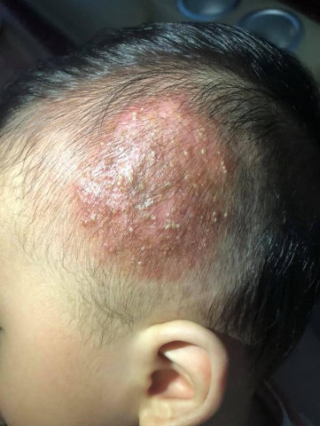 Tuyên Quang: Bé trai 9 tuổi bị nấm tổ ong da đầu do lây từ chó, mèo