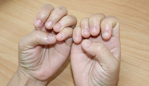 Triệu chứng, nguyên nhân, cách điều trị nấm móng tay