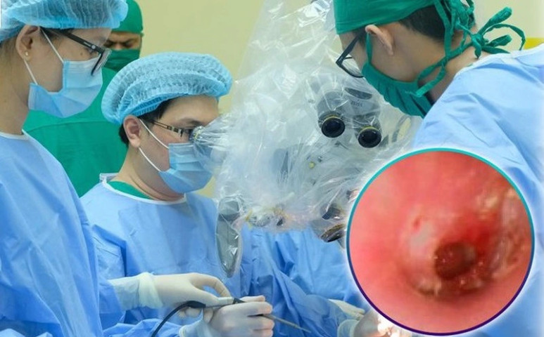 Tây Ninh: Phẫu thuật cho 1 bệnh nhân nữ bị thủng màng nhĩ do viêm tai giữa mạn tính