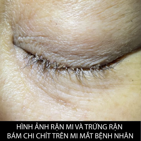 Long An: Rận chi chít, đẻ trứng làm tổ trên mi mắt người phụ nữ 51 tuổi