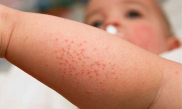 TP. Hồ Chí Minh: Ghi nhận 2 trường hợp mắc bệnh sởi trên trẻ chưa được tiêm vaccine
