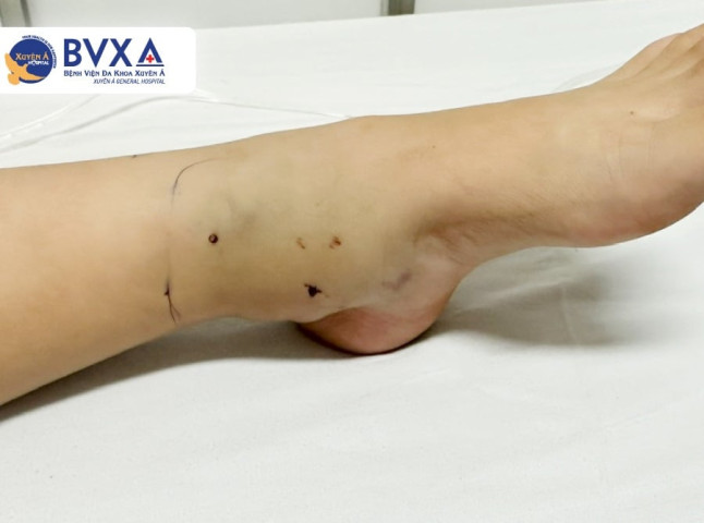 Tây Ninh: Số lượng người phải nhập viện do rắn cắn gia tăng