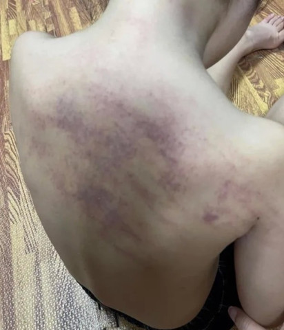Hải Phòng: Kết luận vụ bé 5 tuổi bị bầm tím ở lưng sau khi đi học