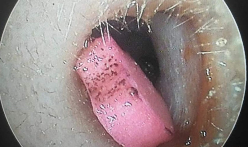 Hà Tĩnh: Bác sĩ gắp cục tẩy để lâu ngày trong tai của bé 5 tuổi