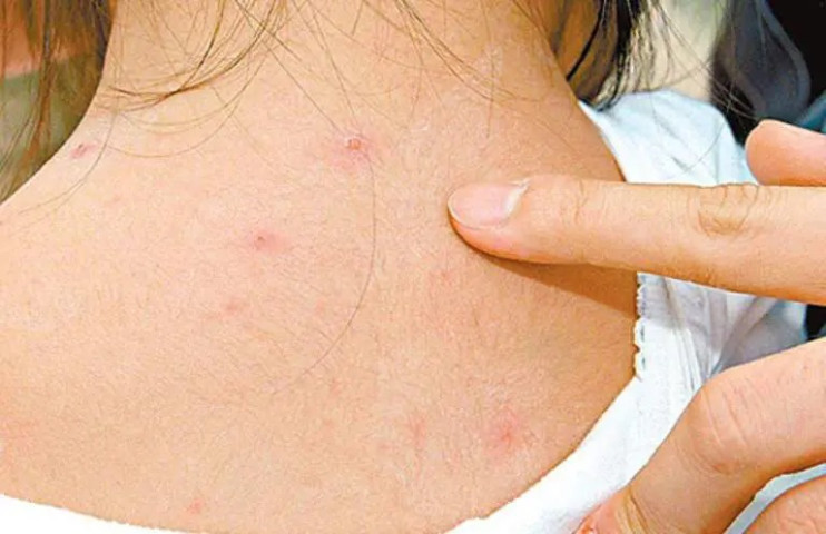 Nghệ An cứu sống trẻ sơ sinh 22 ngày tuổi nhập viện trong tình trạng nguy kịch do mắc thuỷ đậu biến chứng suy hô hấp