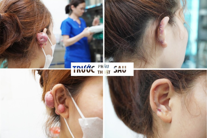 Phú Thọ: Phẫu thuật cắt bỏ sẹo lồi và tạo hình vành tai thành công cho người bệnh nữ 18 tuổi
