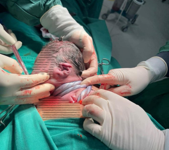 Hà Nội: Cấp cứu thành công thai nhi có dây rau quấn cổ 3 vòng bị suy thai