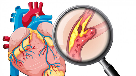 Giảm cholesterol và ngăn ngừa xơ vữa động mạch với Codoca Omega 3.6.9