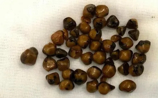 Quảng Nam: Phẫu thuật nội soi cắt túi mật chứa hơn 40 viên sỏi cho bệnh nhân 51 tuổi