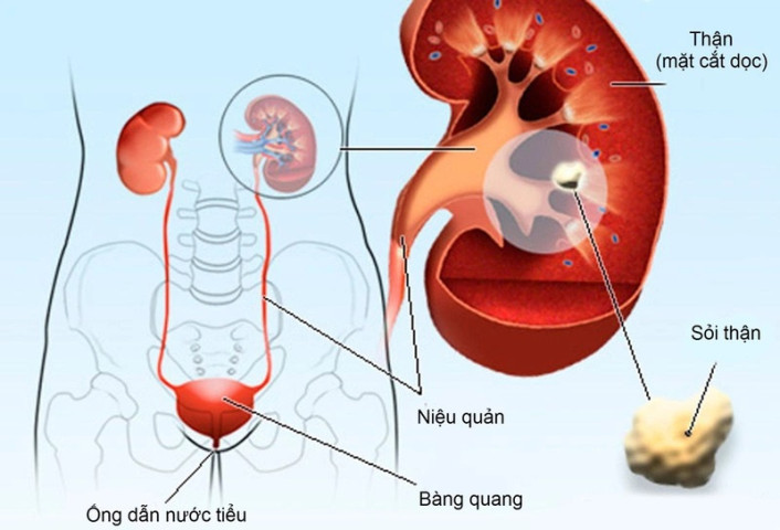 Những thói quen gây ra bệnh lý suy thận bạn có biết?