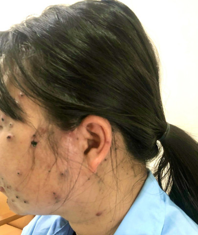 Phú Thọ: Điều trị cho bệnh nhân bị biến chứng thủy đậu do tự ý mua thuốc sử dụng
