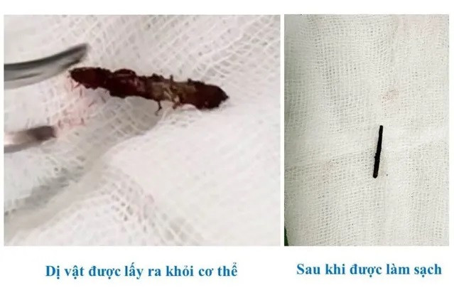 Phú Thọ: Người đàn ông 43 tuổi bị chiếc đinh cắm sâu vào vùng cổ khi làm nghề cơ khí mà không hay biết