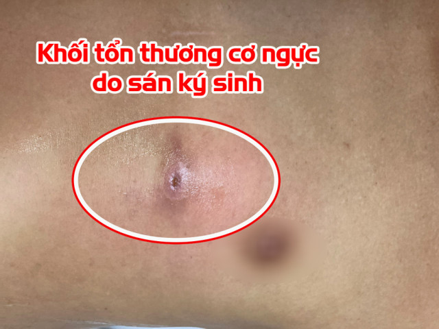 Phú Thọ: Một người đàn ông đến khám và kiểm tra sức khoẻ tại Trung tâm Y tế bất ngờ phát hiện sán não ký sinh khắp cơ thể